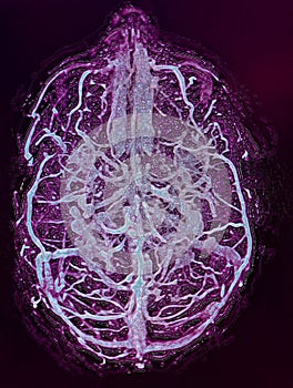 brain veins illustration, MRI