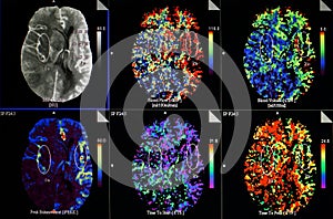 Brain ischaemic stroke. CT-scan reconstruction.