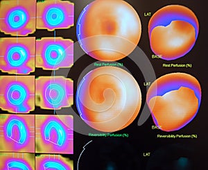 nuclear stress test woman breast attenuation