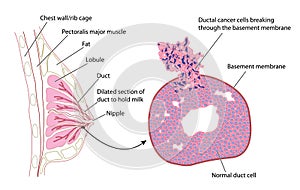 Senos cáncer 