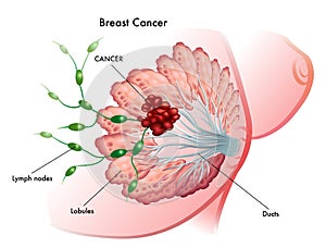 Breast Cancer