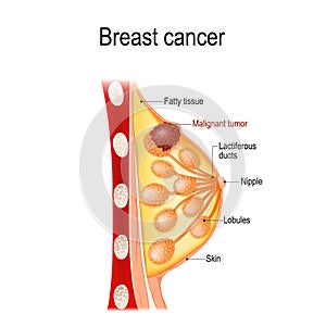 Breast cancer. Cross-section of the mammary gland with tumor