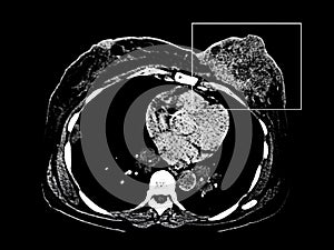 Breast cancer. CT-scan image isolated