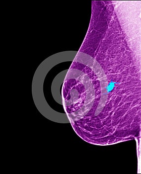 Breast cancer - mammogram photo