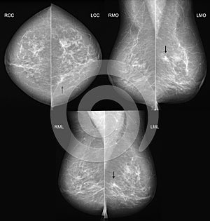 Breast cancer mammography in 3 projections