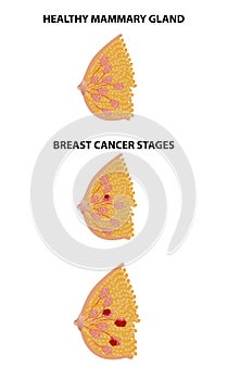Breast cancer realistic vector illustration, medicine