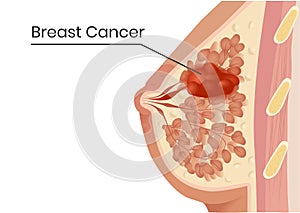 Breast cancer structure. Vector illustration of the lobular carcinoma