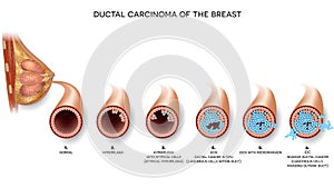 Breast carcinoma