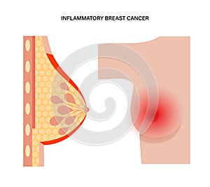 Breast disease concept