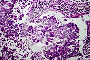 Breast ductal carcinoma, light micrograph