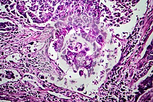 Breast ductal carcinoma, light micrograph