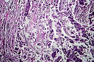 Breast ductal carcinoma, light micrograph