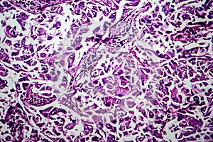 Breast ductal carcinoma, light micrograph