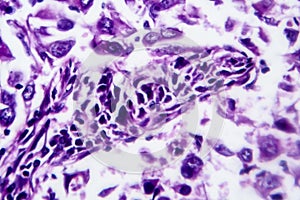 Breast ductal carcinoma, light micrograph
