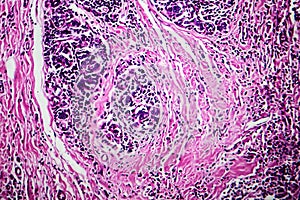 Breast ductal carcinoma, light micrograph