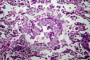 Breast ductal carcinoma, light micrograph