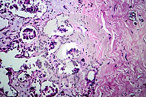 Breast fibroadenosis, light micrograph