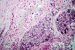 Breast fibroadenosis, light micrograph