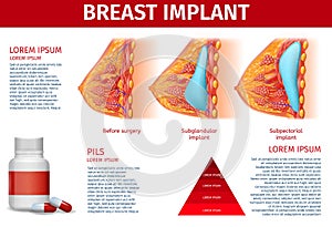 Breast Implant Anatomical Banner, Copy Space.