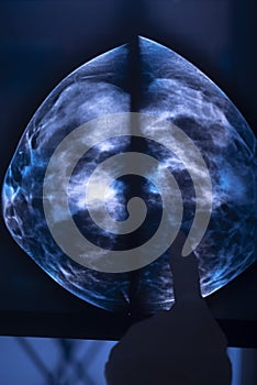 Breast mamogram xray test