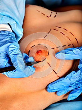 Breast surgery of body part. Implants for augmentation.