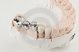 Bridged dental prostheses