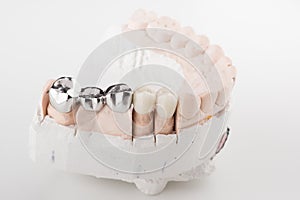 Bridged dental prostheses