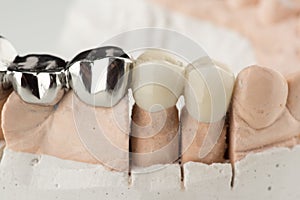 Bridged dental prostheses