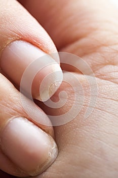 Brittle damaged fingernails