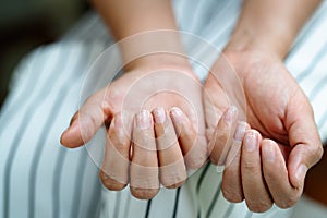 Brittle damaged nails after using shellac or gel-lacquer photo