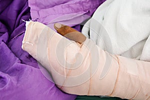 Broken arm bone with splinting