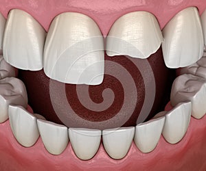 Broken central incisor tooth. Medically accurate 3D illustration of human teeth and dentures