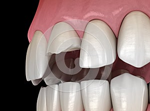 Broken central incisor tooth. Medically accurate 3D illustration of human teeth and dentures