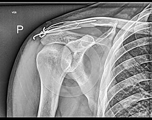 Broken clavicle bone fixation, Fracture repair