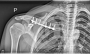 Broken clavicle bone, Shoulder Medical Xray