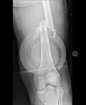 Broken Femur, Knee joint medical Xray