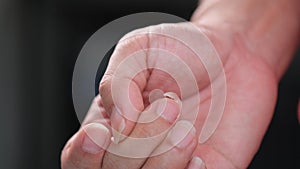 Broken finger nails due to nutritional deficiencies.