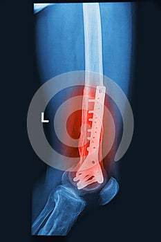 Broken human thigh x-rays image with implant
