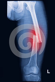 Broken human thigh x-rays image