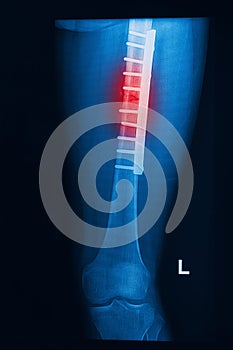 Broken human thigh x-rays image with implant