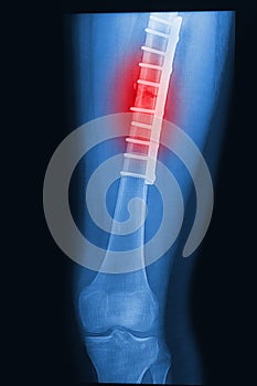 Broken human thigh x-rays image with implant