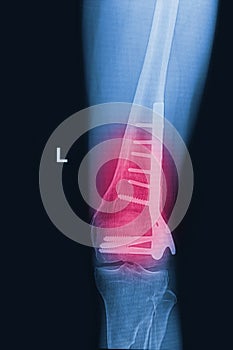 Broken human thigh x-rays image with implant
