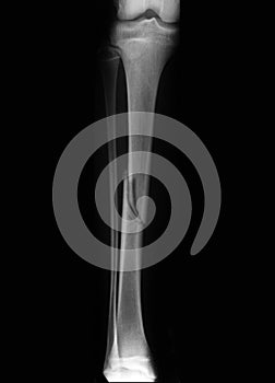 Broken leg (broken tibia) radiography photo