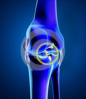 Broken posterior cruciate ligament. Injury and rupture. Anatomy