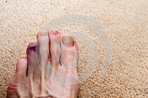 Broken toe showing bruising on skin due to injury