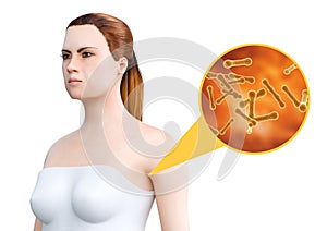 Bromhidrosis is a condition in which body sweating is accompanied by an unpleasant sweat