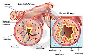 Bronchial asthma photo