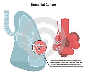 Bronchial cancer. Pathological malignant cells or tumor located