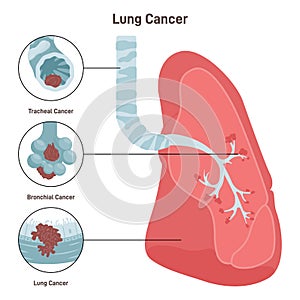 Bronchial cancer. Pathological malignant cells or tumor located