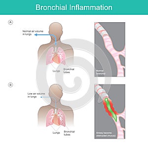 Bronchial Inflammation. Illustration.